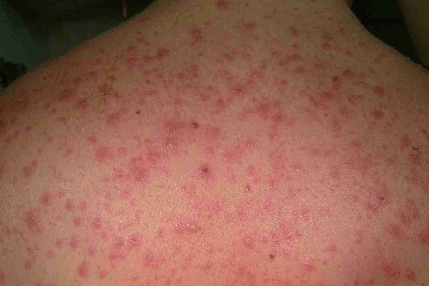 monkeypox south africa