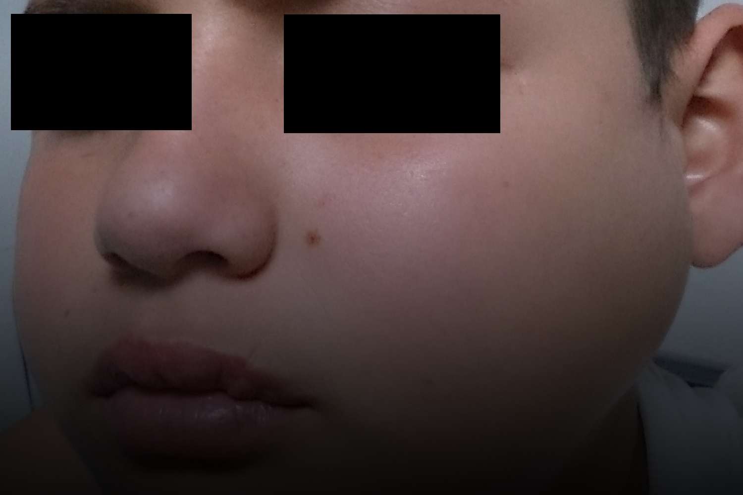 mumps