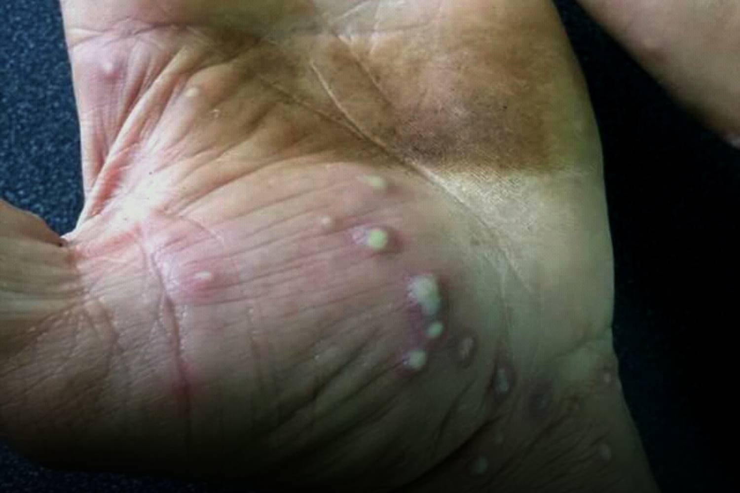hand foot moth disease
